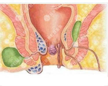 南寧哪個醫(yī)院可以做肛周膿腫？